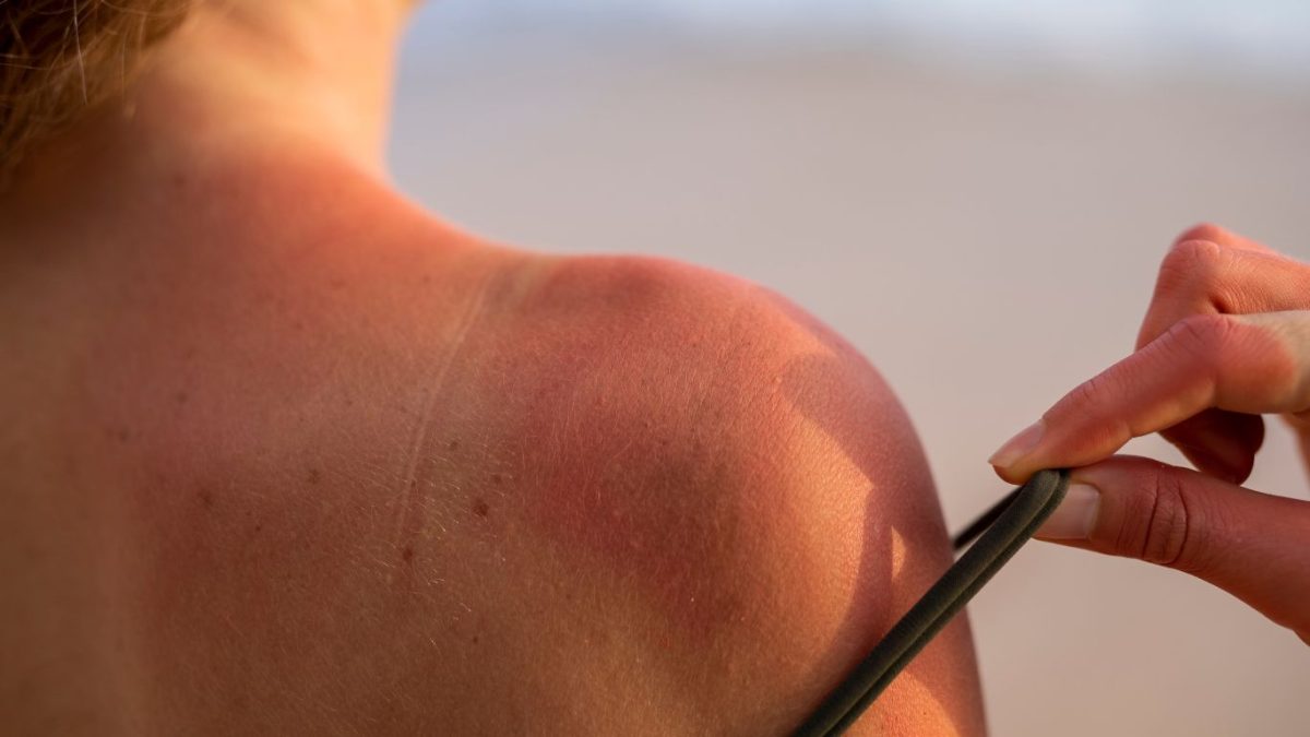 Clínica de bronzeamento é condenada a indenizar cliente que sofreu queimaduras de segundo grau
